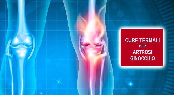 Cure termali per artrosi ginocchio